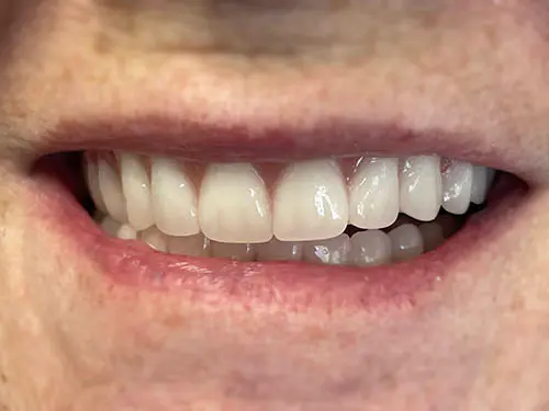 Implant-supported-denture-after