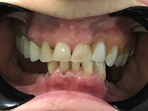 Implant-supported-denture-before