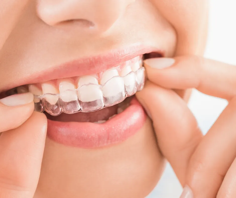Clean-Invisalign