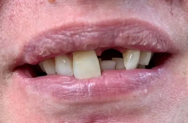 Replace-missing-teeth-before