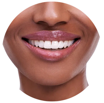 Bright smile teeth whitening result
