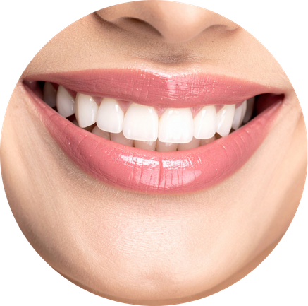 A woman smiling and showing teeth whitening