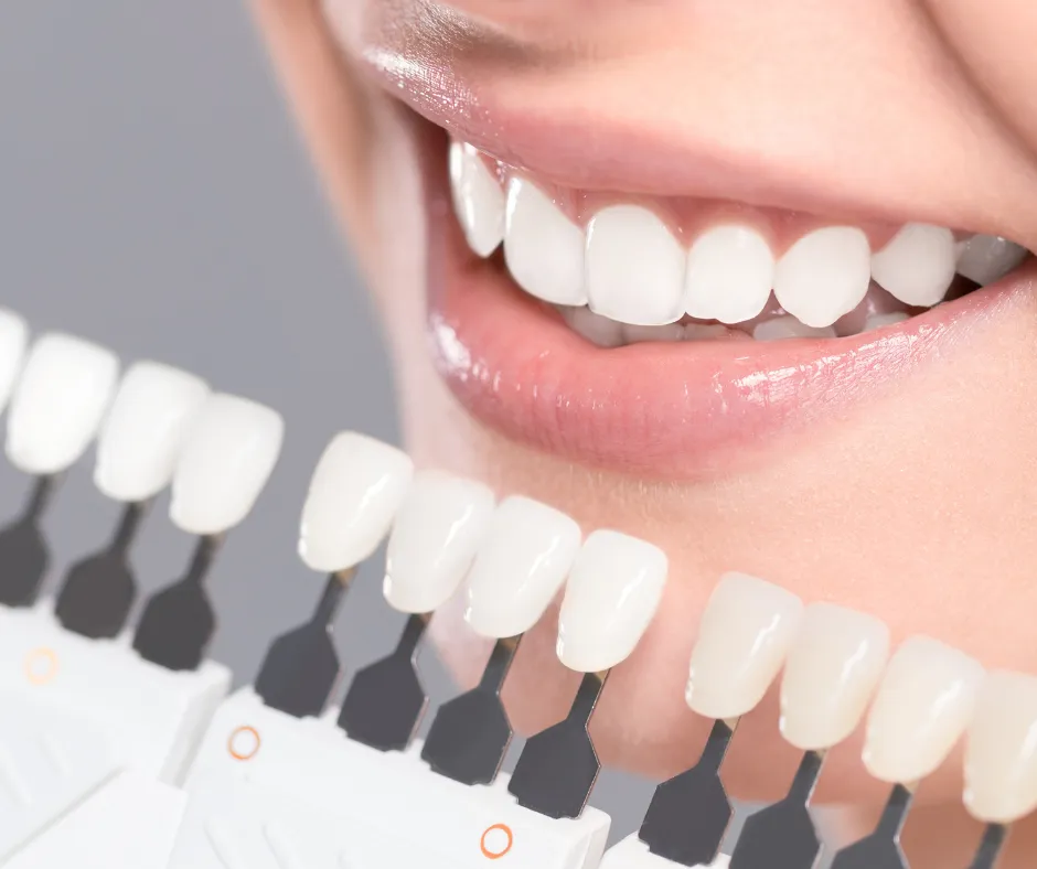 Teeth shade guide whitening comparison in Wethersfield CT