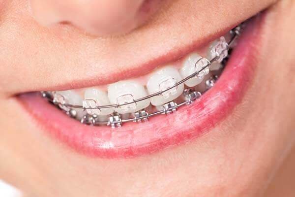 Benefits of Clear Braces. How do braces work?
