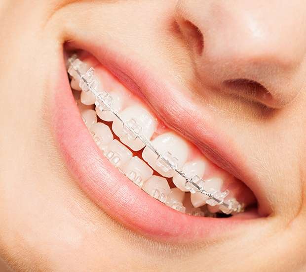 Clear Braces for Straightening Teeth | Wethersfield, CT