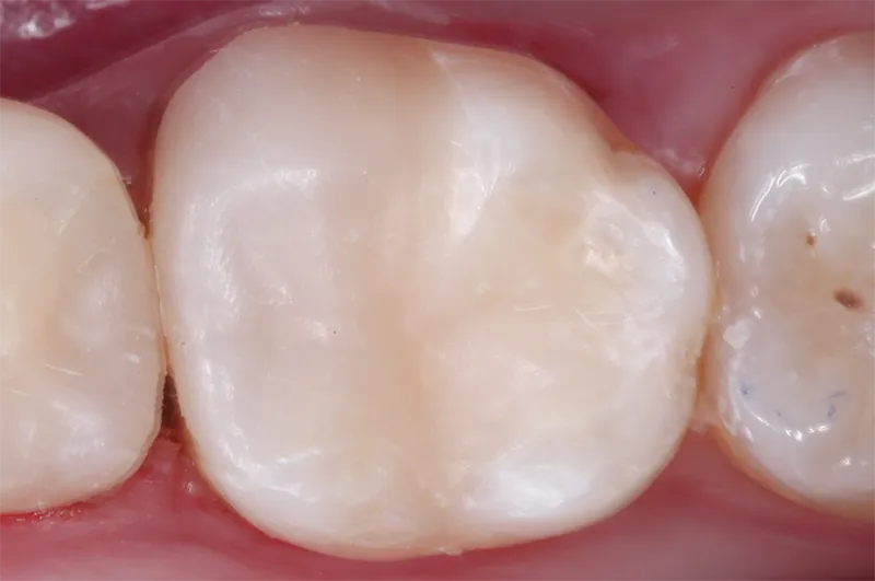 Clean molar tooth occlusal view