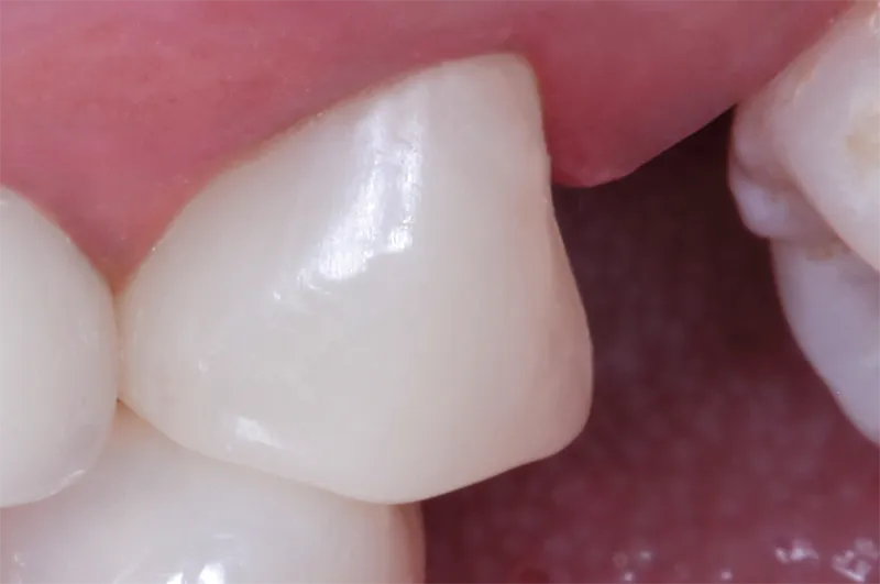 Dental crown restoration close-up