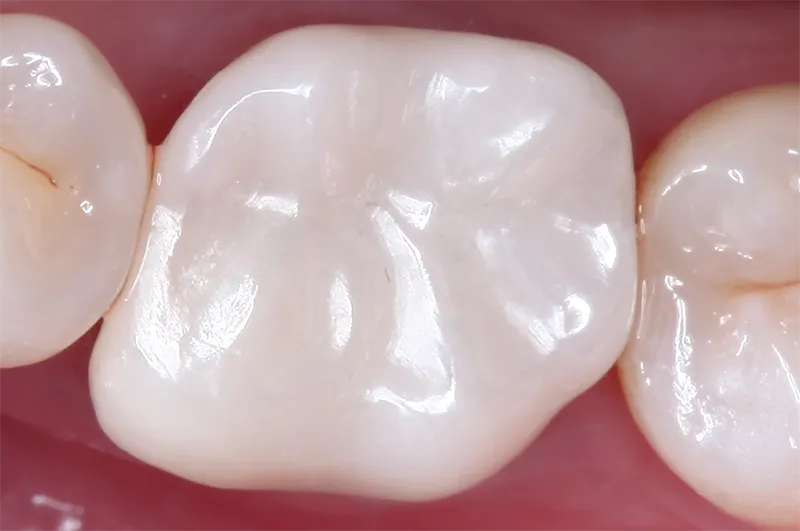 Tooth-colored filling cosmetic dentistry