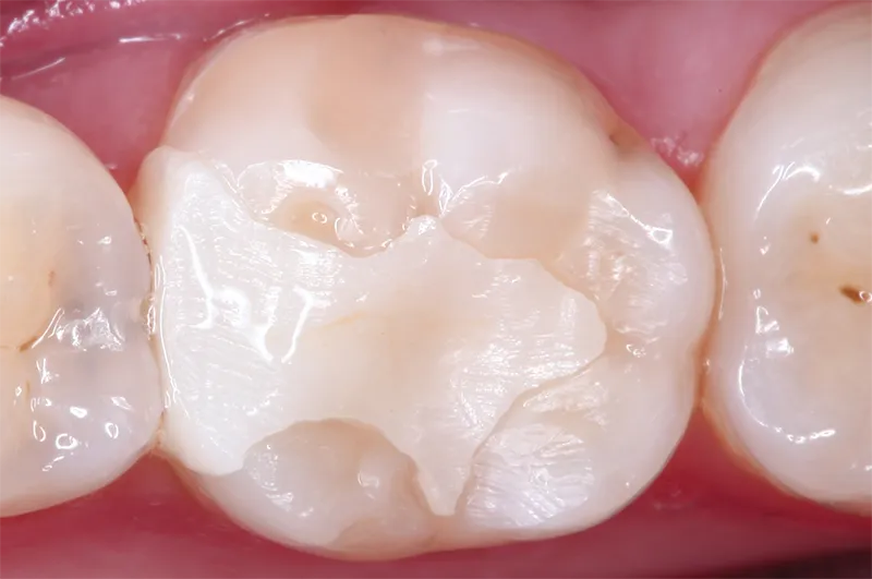 Healthy molar tooth surface