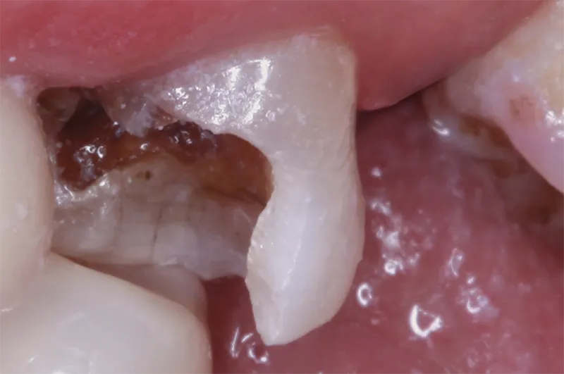 Tooth decay cavity close-up treatment