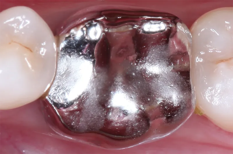 Amalgam filling tooth restoration