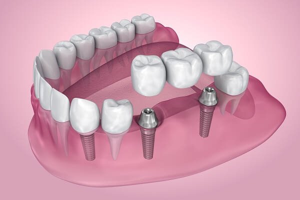 Dental implants model teeth restoration