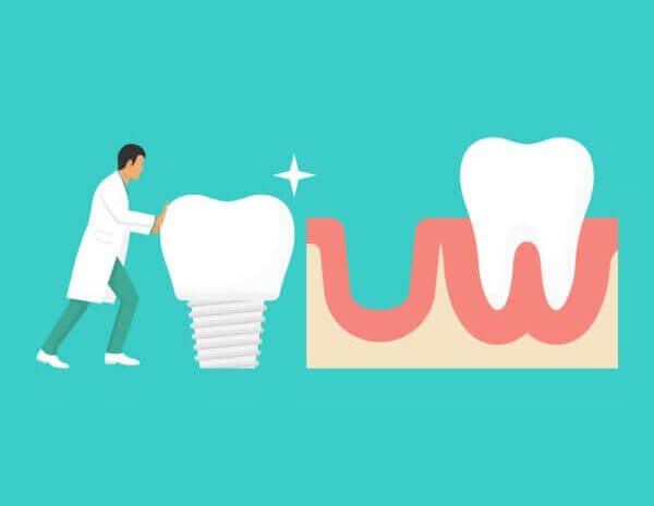 6 Reasons to Visit a Dental Implants Professional -