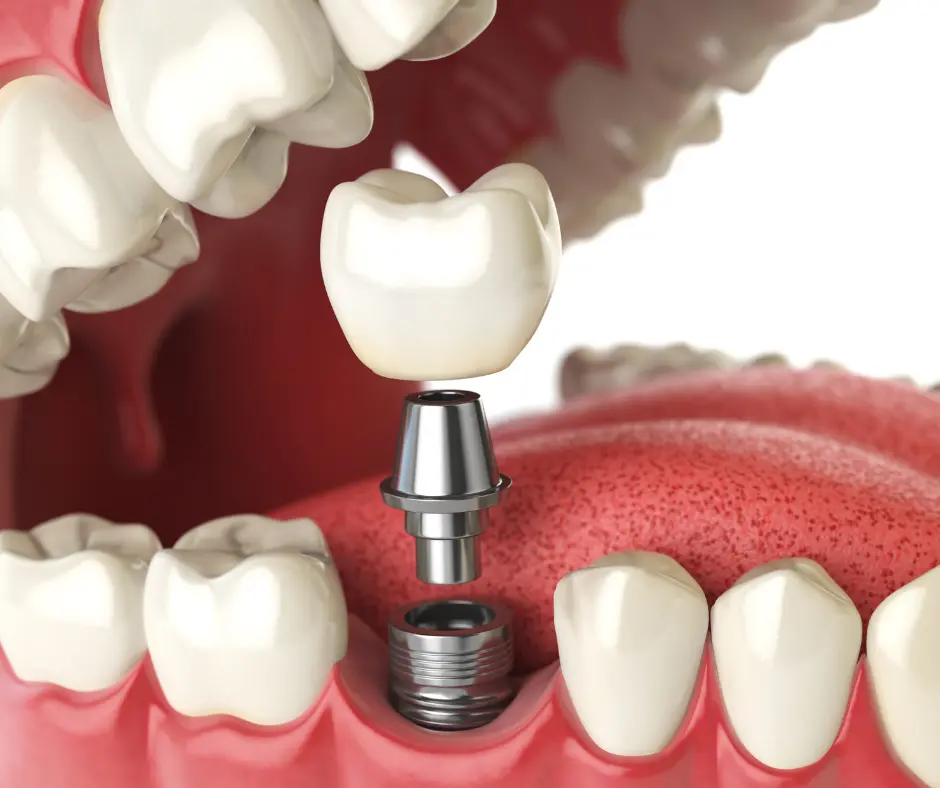 Dental implant procedure illustration in Wethersfield CT