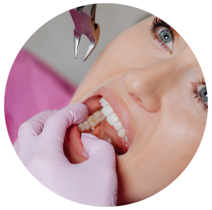 Dental filling procedure close-up in in Wethersfield CT