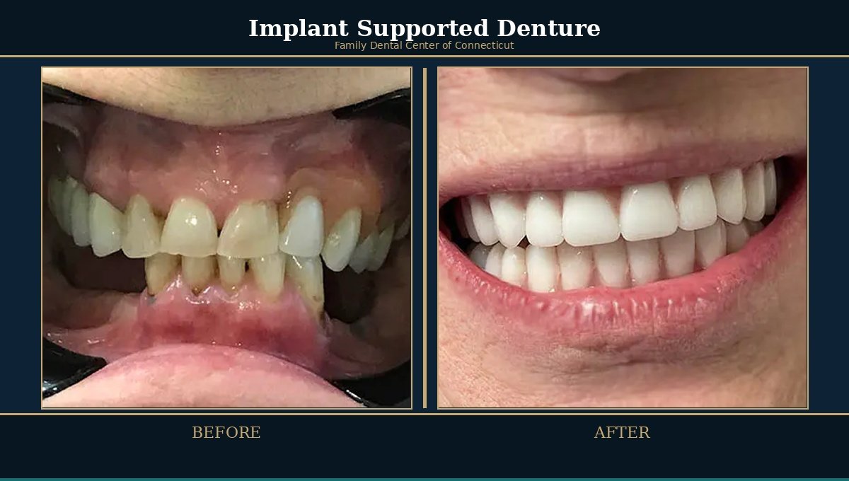 Implant supported denture options at Family Dental Center of Connecticut
