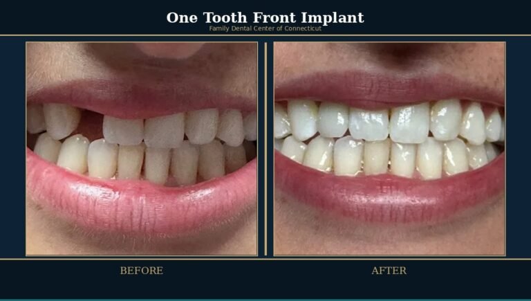 Dental Implants in Wethersfield, CT: Candidacy, Types & What to Expect