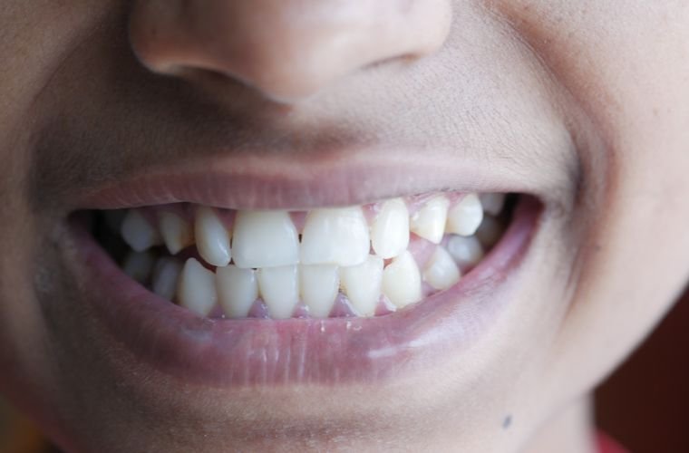 Close-up of a healthy smile comparing veneers vs. dental bonding at a Wethersfield CT dentist
